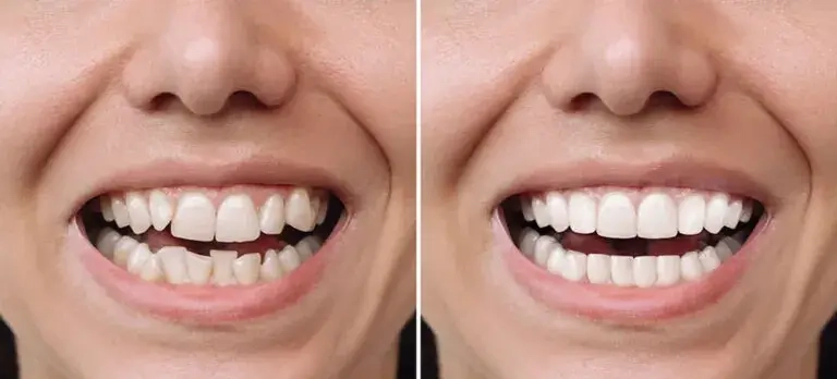 کامپوزیت دندان در ساوه - ترمیم زیبایی و لیرینگ دندان