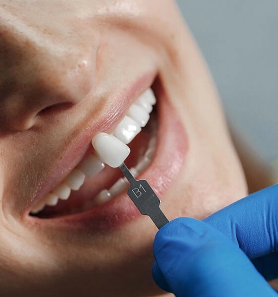 تصویری از لمینت دندان‌ها برای اصلاح طرح لبخند