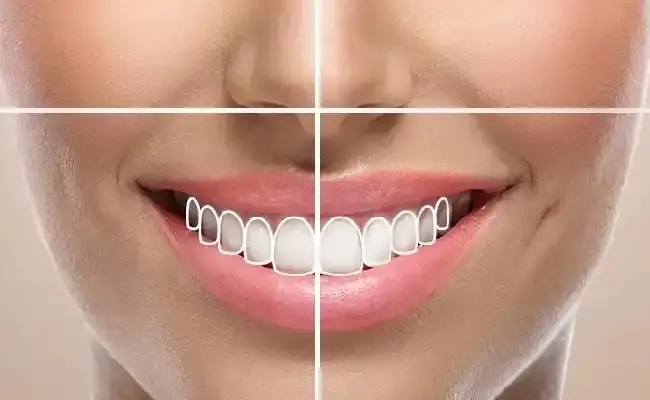 تصویری از طراحی لبخند دیجیتال